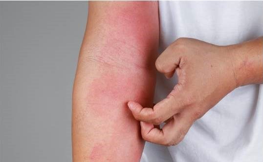 atopiki -dermatitida-therapeia